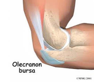 Olecranon Bursitis London | Elbow Pain Treatment London